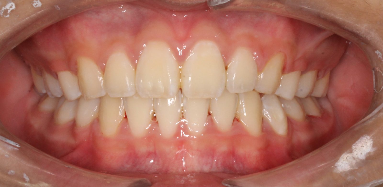 Sourire aligné après traitement orthodontique