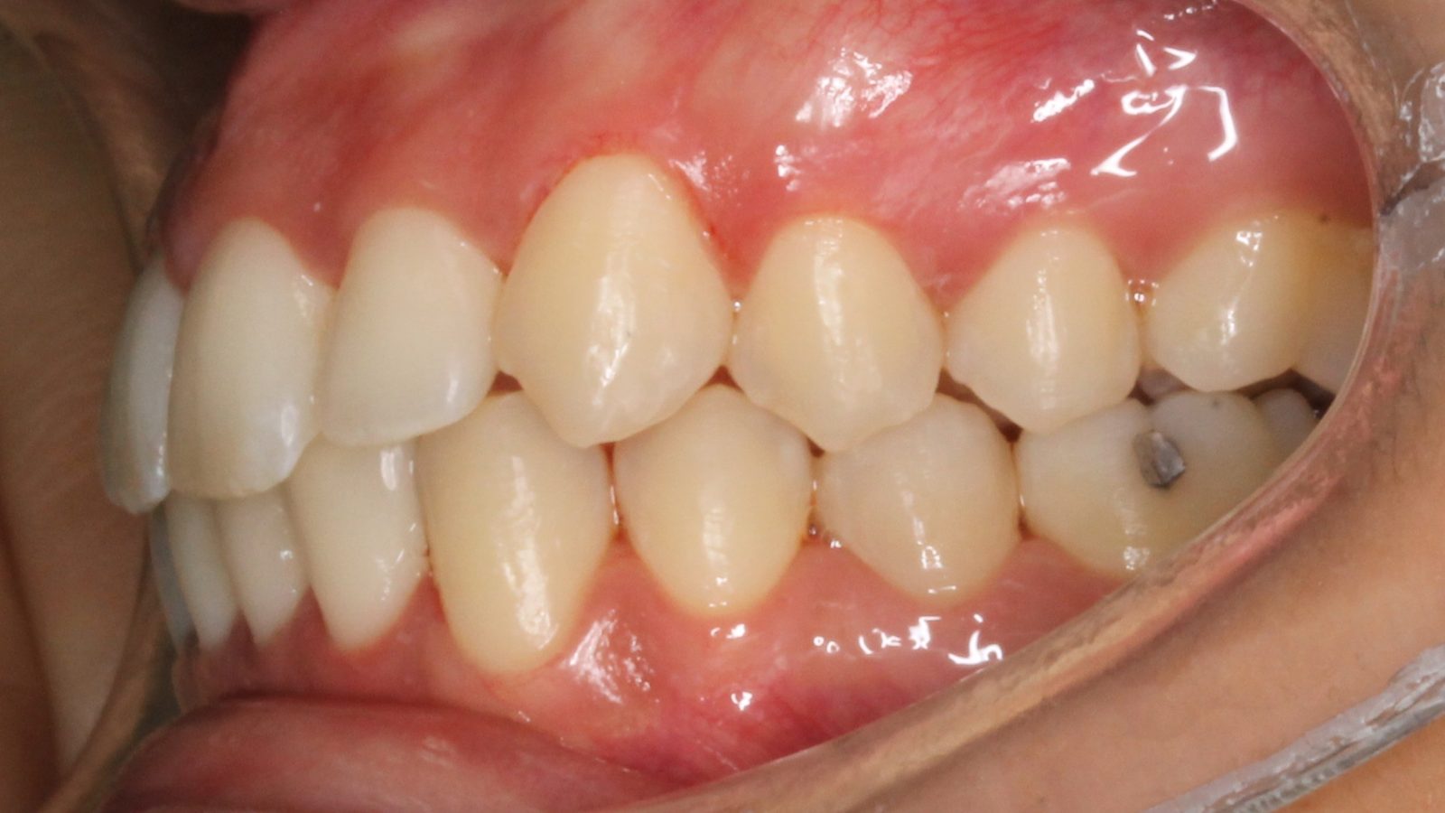 Résultat après chirurgie de la mâchoire et orthodontie linguale