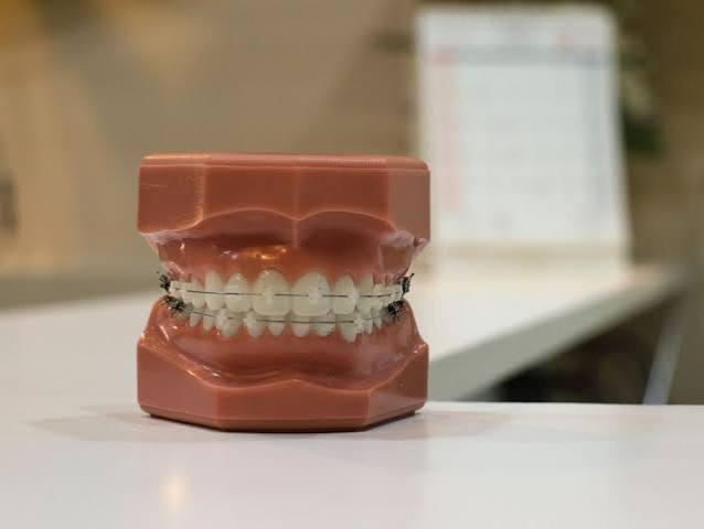 Les bagues céramiques : des brackets de la même couleur que la dent, plus discrets.