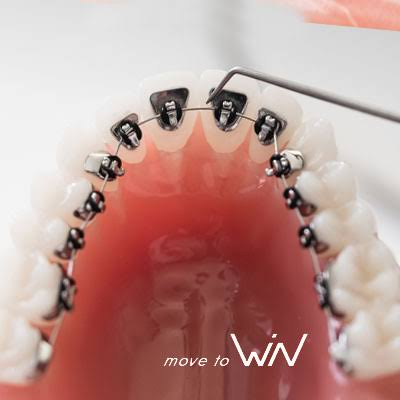 Bagues linguales WIN vues sur la face interne des dents.