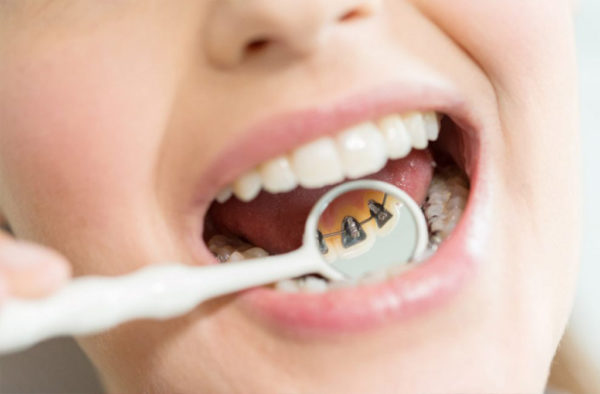 Détail des brackets linguaux sur-mesure, invisibles de face.